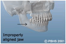 Orthoganthic Surgery, Jaw Surgery, Bakersfield CA